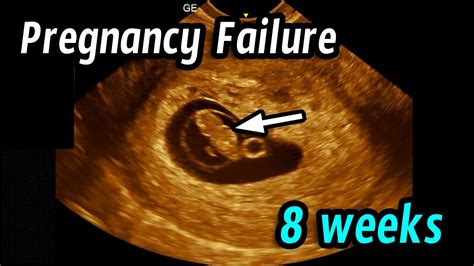Miscarriage 8 week ultrasound - Statistics by Weeks for Miscarriage after Seeing Heartbeat. After heartbeat is detected, risk of miscarriage is 9.4% at 6 weeks; 4.2% at 7 weeks; 1.5% at 8 weeks; 0.5% at 9 weeks. To estimate the risk of miscarriage among asymptomatic women after a prenatal go to between 6 and 11 weeks of gestation where evidence of fetal viability of a ...